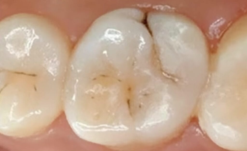 Teeth Surface Black Stains overtreatment of cavities