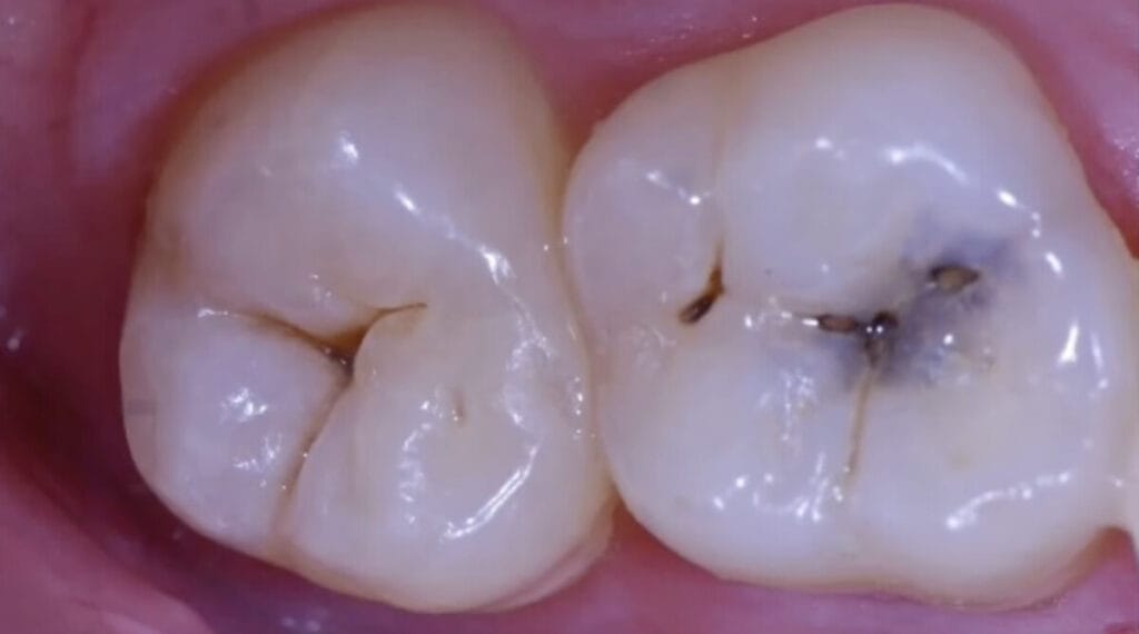 Teeth required to treat tooth decay