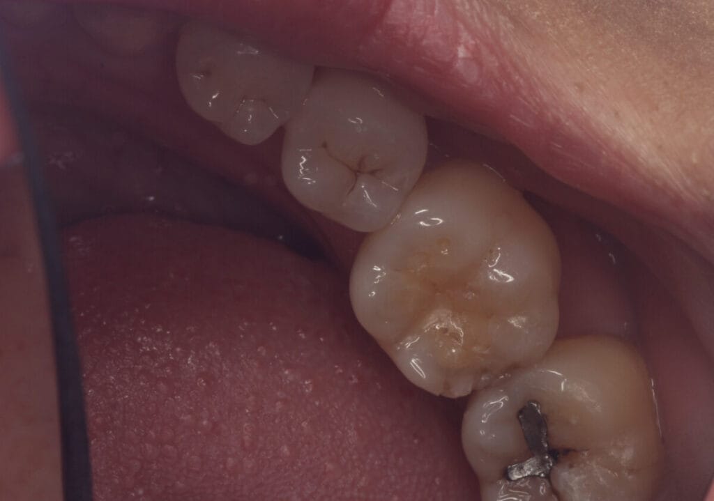 Cavity treatment methods for a tooth with decay that needs treatment.